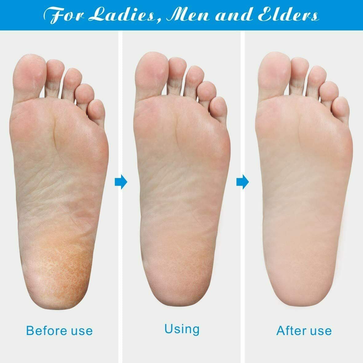 Foot Callus Remover File Rasp Scraper